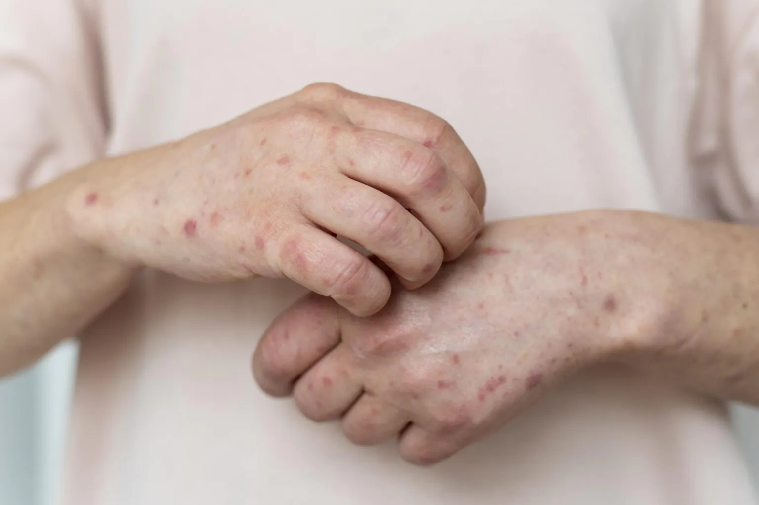 Impetigo Treatment UK