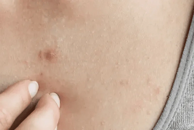 infected insect bite treatment