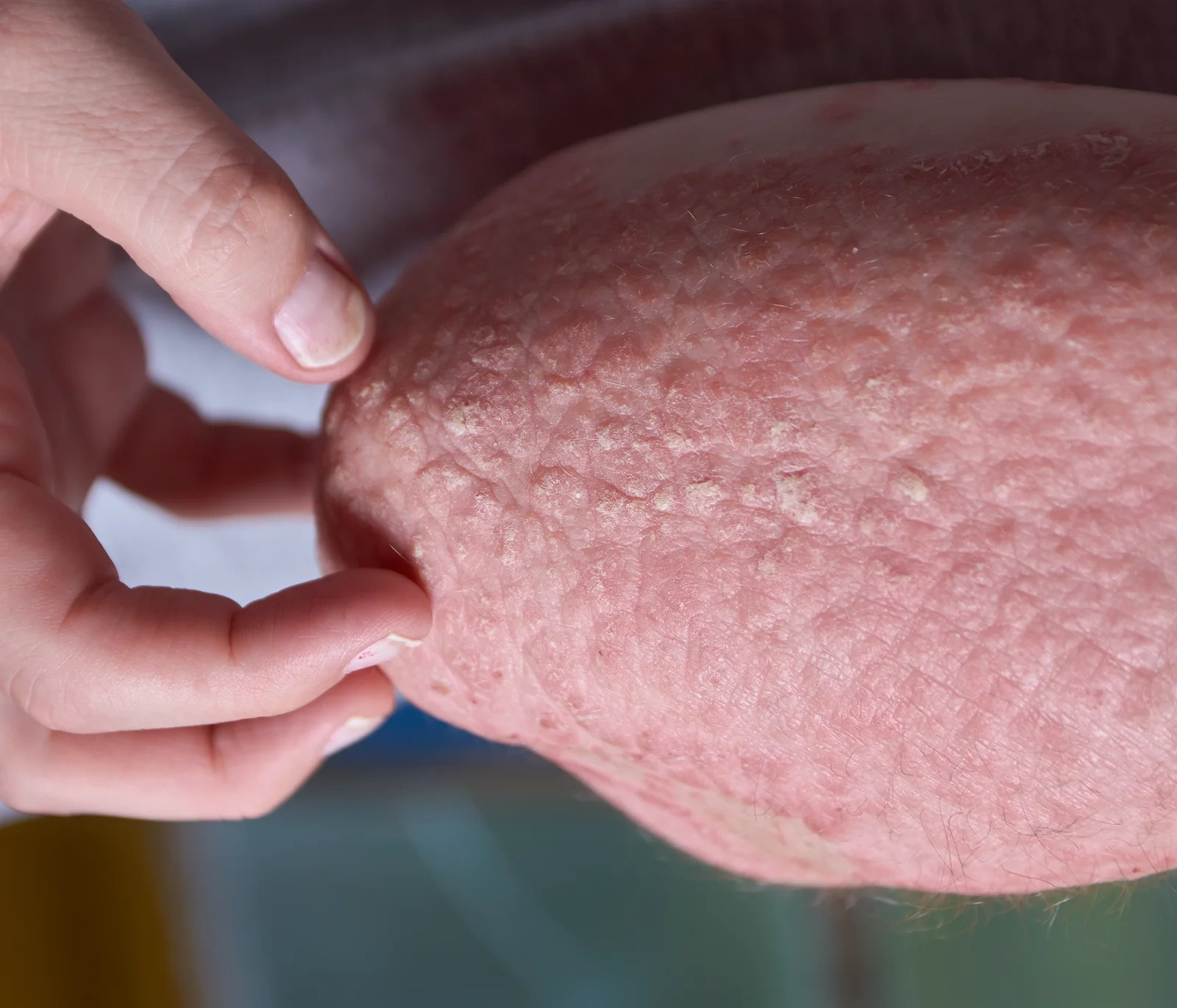 shingles-hand-1-scaled